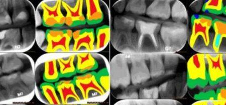 پوسیدگی دندان با استفاده از هوش مصنوعی تشخیص داده شد