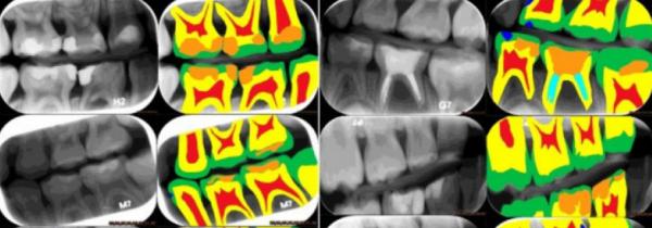پوسیدگی دندان با استفاده از هوش مصنوعی تشخیص داده شد